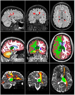 Damage in the Thalamocortical Tracts is Associated With Subsequent Thalamus Atrophy in Early Multiple Sclerosis